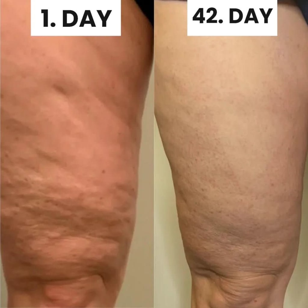 Cellulite Relief