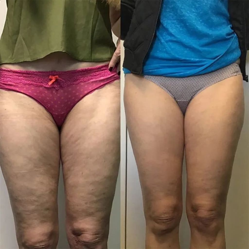 Cellulite Relief