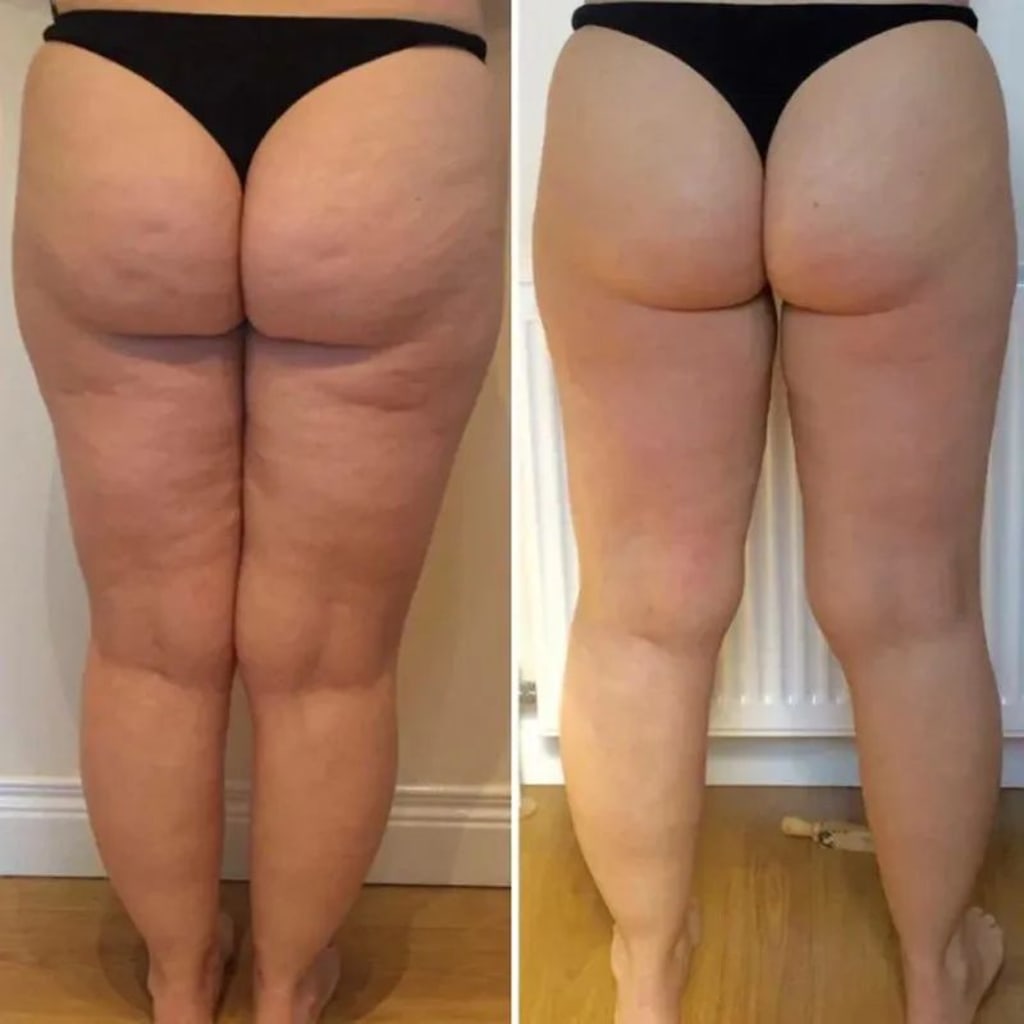 Cellulite Relief